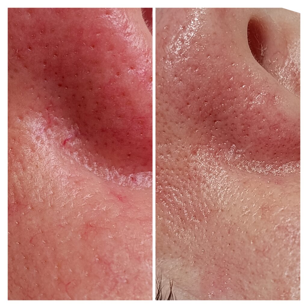 Zamykanie Naczynek  Znamion Rubinowych Bydgoszcz 10